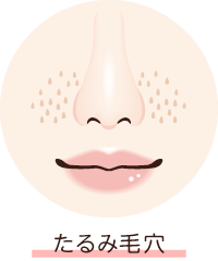 たるみ毛穴