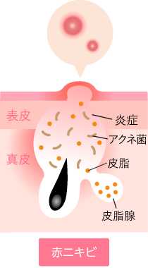 赤ニキビ