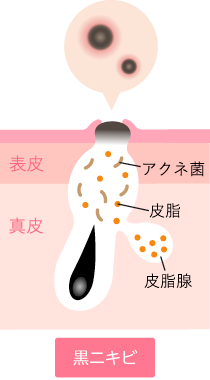 黒ニキビ
