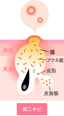 黄ニキビ