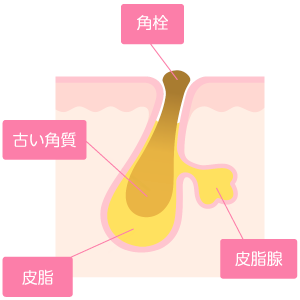 角栓ができる原因