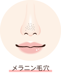メラニン毛穴（黒ずみ・いちご鼻）