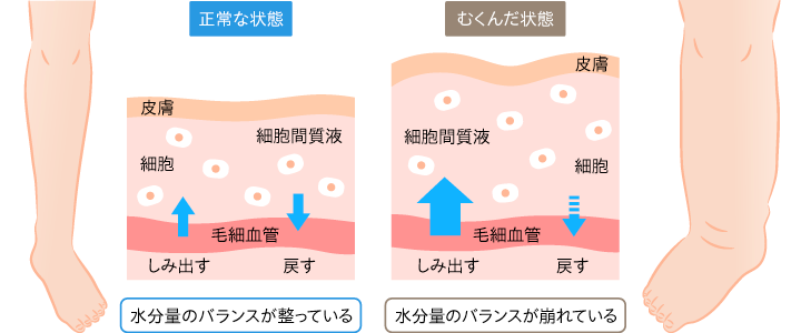 むくみとは？