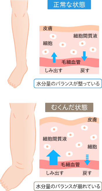 むくみとは？