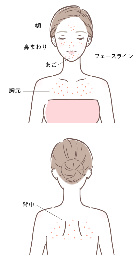 ニキビができやすいパーツ