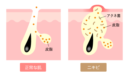 ニキビとは？