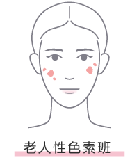 老人性色素斑