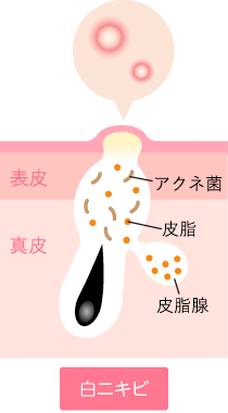 白ニキビ