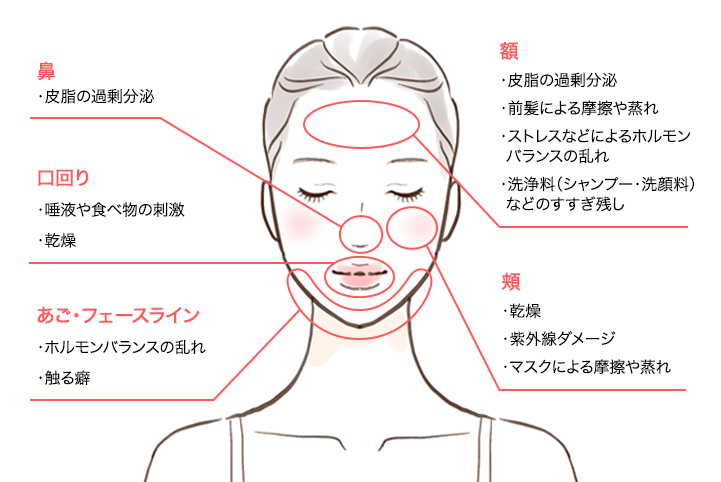 肌荒れが起こる場所ごとの原因